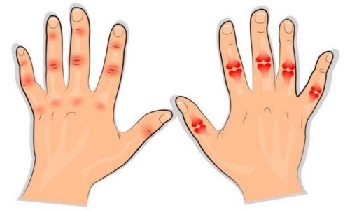 От какво боледуват ставите на пръстите?