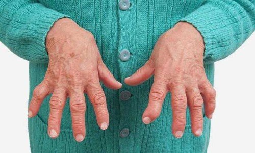 Ревматоиден артрит: всичко по темата – част 1