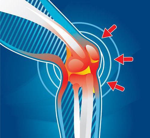 Болките в коленната става могат да са причинени от травми на менискуса, разместване на коленната капачка, разтягане на връзки, заболяване на ставите
