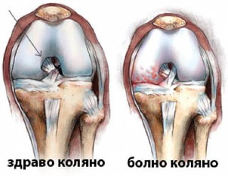 Болката в областта на коленете възниква при ставно възпаление.