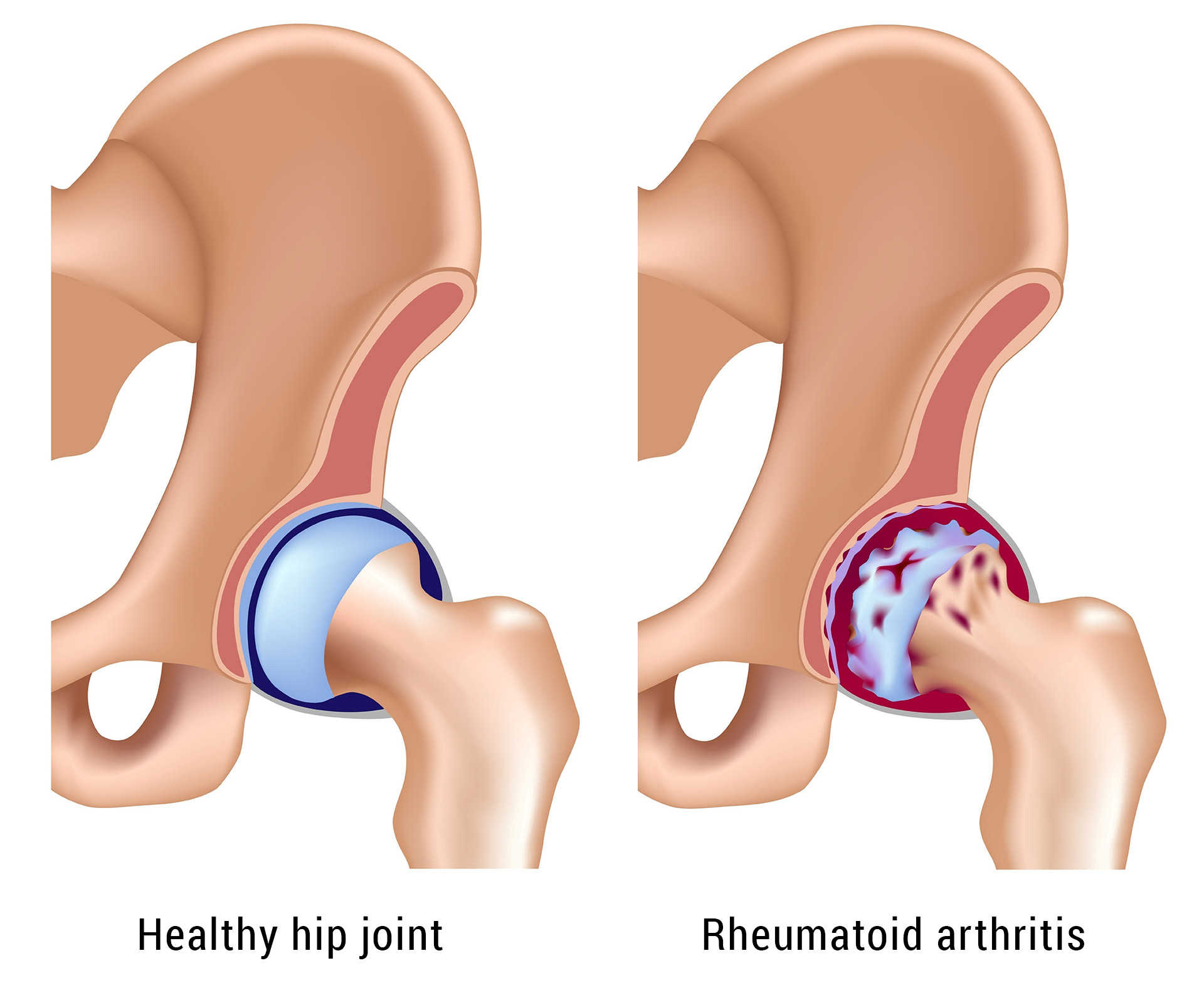 Ревматоиден артрит е ставно заболяване, което причинява оток на ставите и възпаление