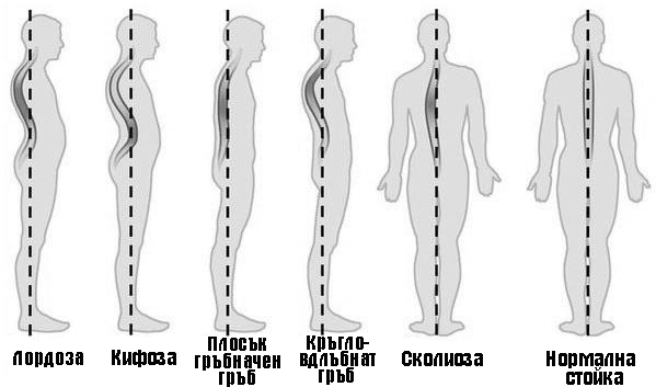 Съществуват следните видове патологични гръбначни изкривявания:  Лордоза – изкривяване напред; Кифоза – изкривяване назад; Сколиоза – изкривяване настрани; Кифосколиоза – комбинирано изкривяване.
