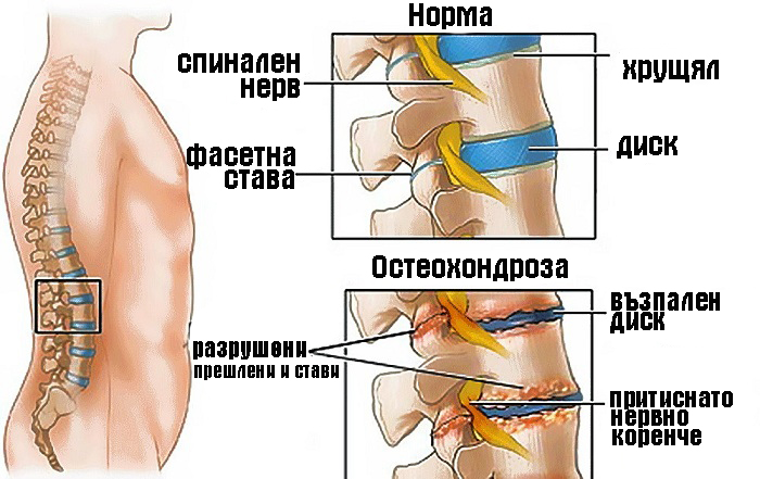 Остеохондрозата е дегенеративно-дистрофично изменение (разрушение) на костната тъкан на гръбначния стълб, ставните хрущяли, връзковия апарат и междупрешленните дискове. 