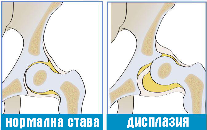 В зависимост от степента на дисплазията се дели на:  Луксация (когато главата на бедрената кост се измества и без трудност влиза в ацетабулума) Сублуксация (главата на тазобедрената става частично се измества, което води до преразтягане на връзковия апарат на ставата) Изместване на тазобедрената става (главата на бедрото е извън пределите на ацетабулума).