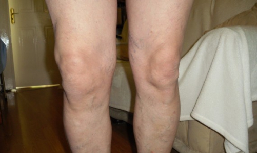 Симптомите на артрит на коляното зависят от вида артрит, но винаги присъства болка и оток на ставата