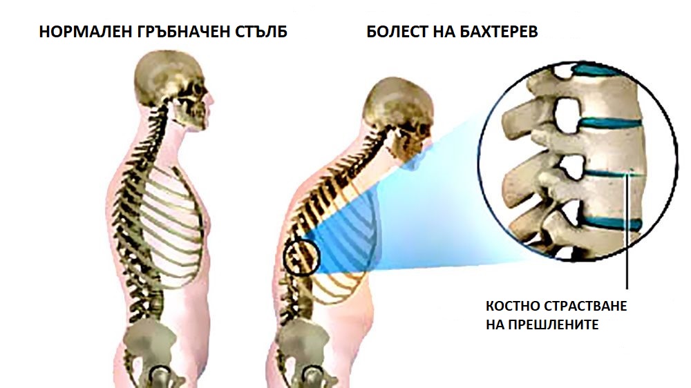 При синдром на Бахтерев прешлените на гръбначния стълб се срастват - вкостеняват