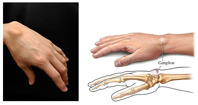Хигрома на китката и болест  на Кревен причиняват ставна болка в ръцете