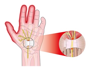 Синдром на карпалния канал причинява болка в ставите на ръцете