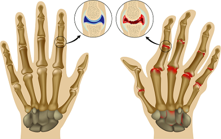 Болки в ръцете може да са провокирани от ревматоиден артрит, остеопороза