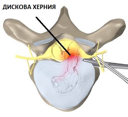 Причина за дискова херния може да е остеохондроза на гръбначния стълб