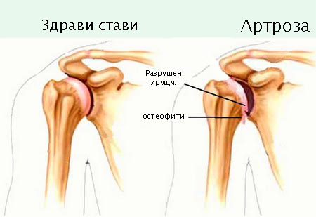 За разлика от артрита, който засяга ставната капсула, при артроза се уврежда хрущялната, а с времето и костната тъкан. 