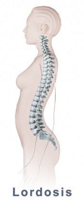 Лордоза е заболяване на гръбначния стълб, което се изразява в изкривяване на гръбнака в шийния, поясния или гръдния отдел