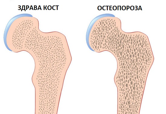 Остеопороза е заболяване на костите чрез разреждането им