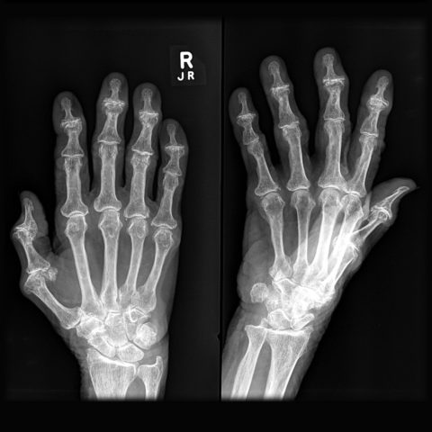 Диагностиката и лечението на болестите на пръстите трябва да е своевременно и грамотно