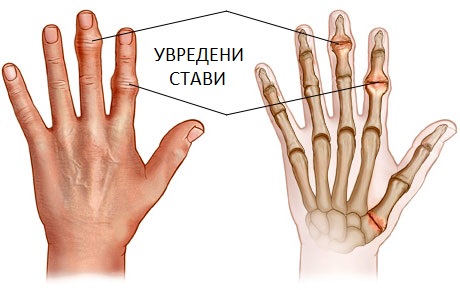 Степени на увреждане ставите на пръстите на ръцете