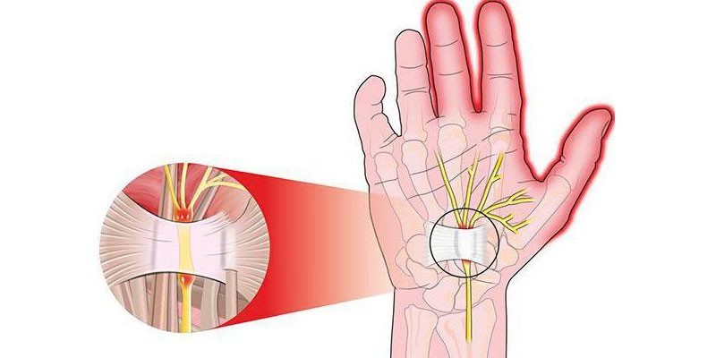 Болест на Де Кервен причинява силни болки в областта на палеца и китката заради стеснения канал на сухожилието на палеца