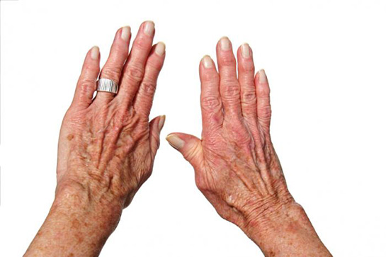Ревматоиден артрит причинява деформация на ставите