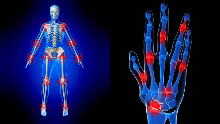Рентгеновата снимка показва наличието на заболяването ревматоиден артрит