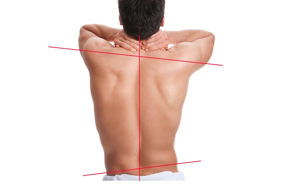Сколиоза е заболяване на гръбначния стълб, при което гръбнакът се изкривява странично