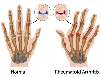 Възпалението и отокът на китките и глезените е признак за ревматоиден артрит. 