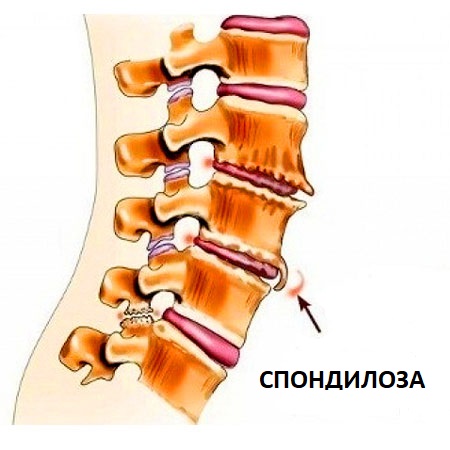 Спондилоа е заболяване на гръбначния стълб, при което се появяват костни израстъци - остеофити