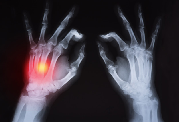 При артроза на пръстите на ръцете се увреждат фалангите на пръстите и се деформират