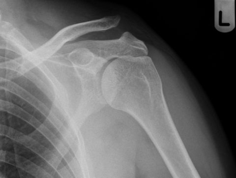 Един от начините за поставя не диагноза артроза на раменни стави е рентгенографията