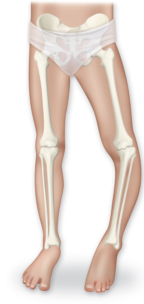 Болест на Блаунт е деформация на горната част на крака, която се наблюдава при деца вродено и при процес на растежа