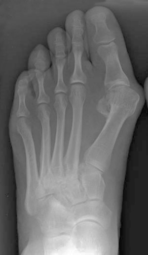 Диагнозата Hallux valgus се поставя чрез рентгенологични изследвания на стъпалото на крака