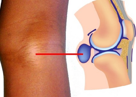 При голям размер на кистата на коленната става се провежда операция