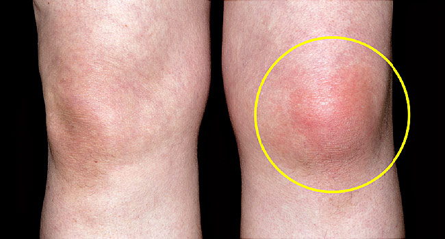 При вода в коляното се получава оток на коленната става, появява се болка.