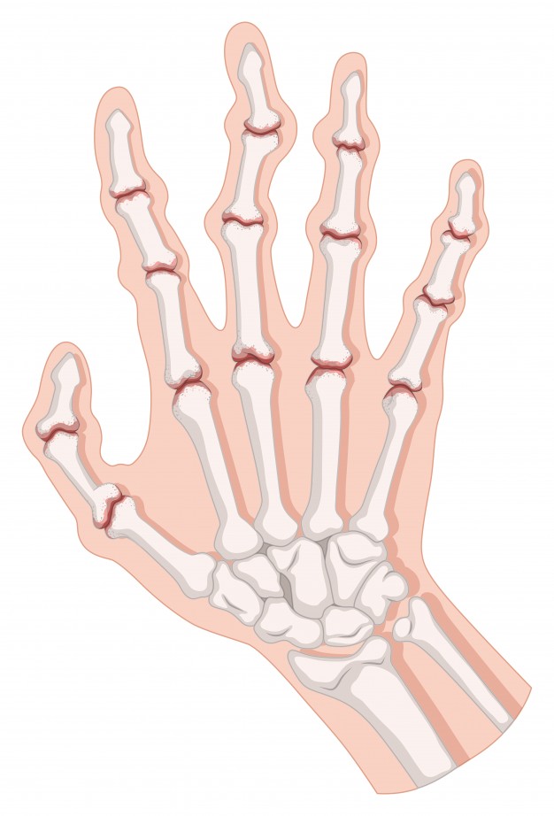 Артрит е възпалително заболяване на ставите, което се среща често при пръстите на ръцете и налага своевременно лечение