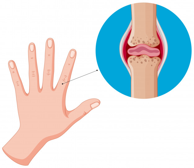 За домашно лечение на артрит на пръстите се препоръчва използването на вани, компреси, разтривки и други методи от народната медицина.